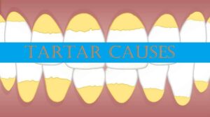 What Causes Tartar Buildup on Your Teeth?