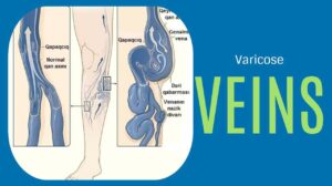 Varicose Veins: Causes, Severity Score, and Treatment