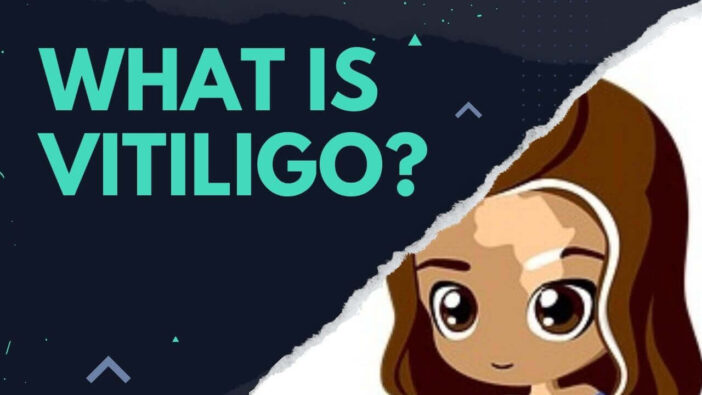 What is Vitiligo