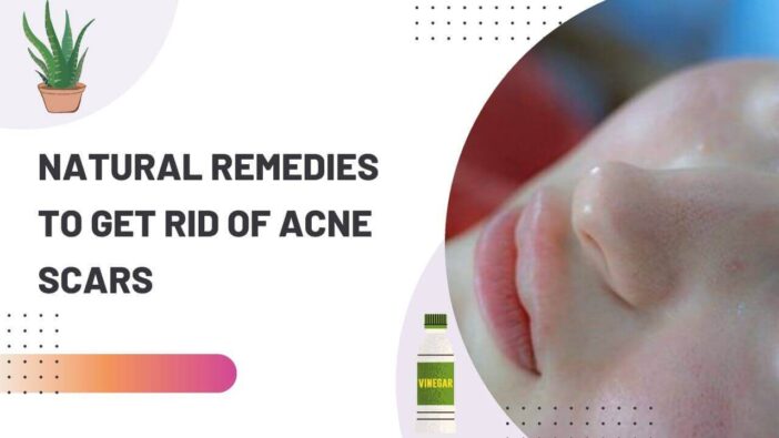 Natural Remedies To Get Rid of Acne Scars