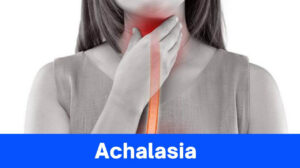 Achalasia: Causes – Symptoms and Treatment [Complete Explanation]