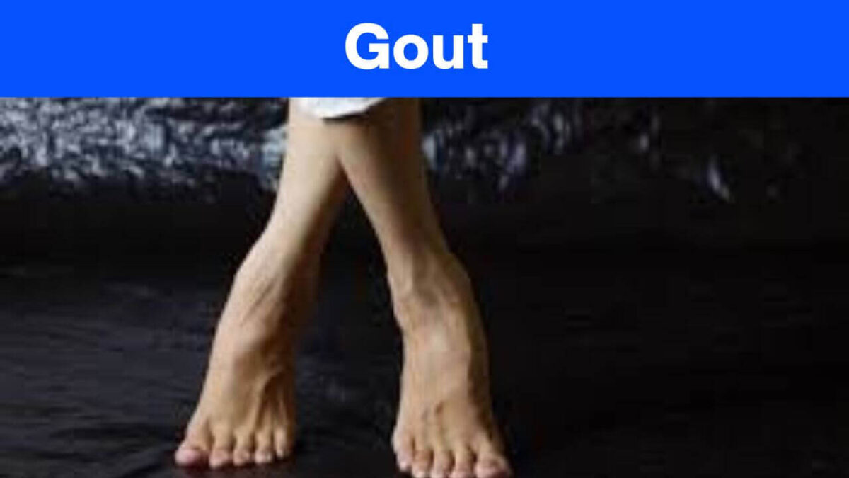 Gout Vegetables To Avoid, And The Signs » 2024