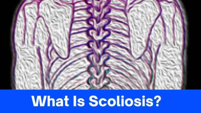 What Is Scoliosis