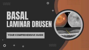 Unlocking the Secrets of Basal Laminar Drusen: Your Comprehensive Guide